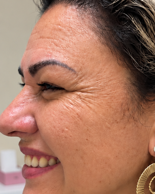 Botox para pés de galinha: suavidade para o seu olhar — Antes