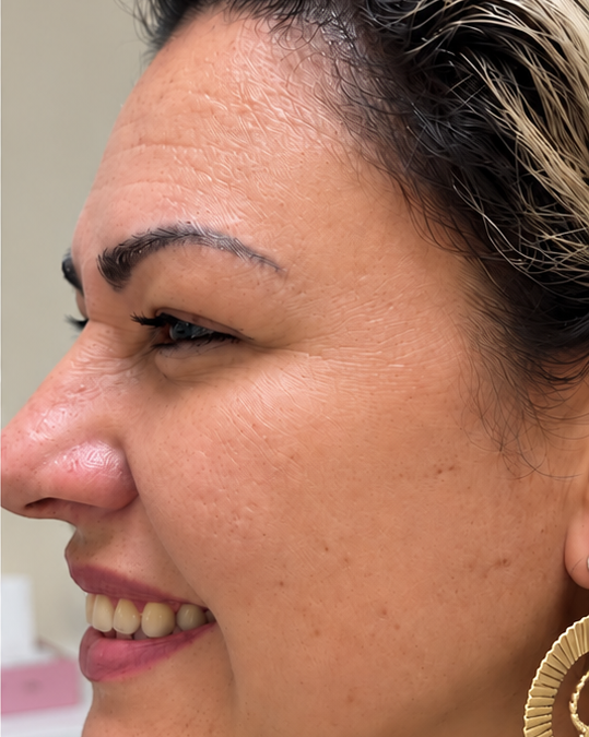Botox para pés de galinha: suavidade para o seu olhar — Depois